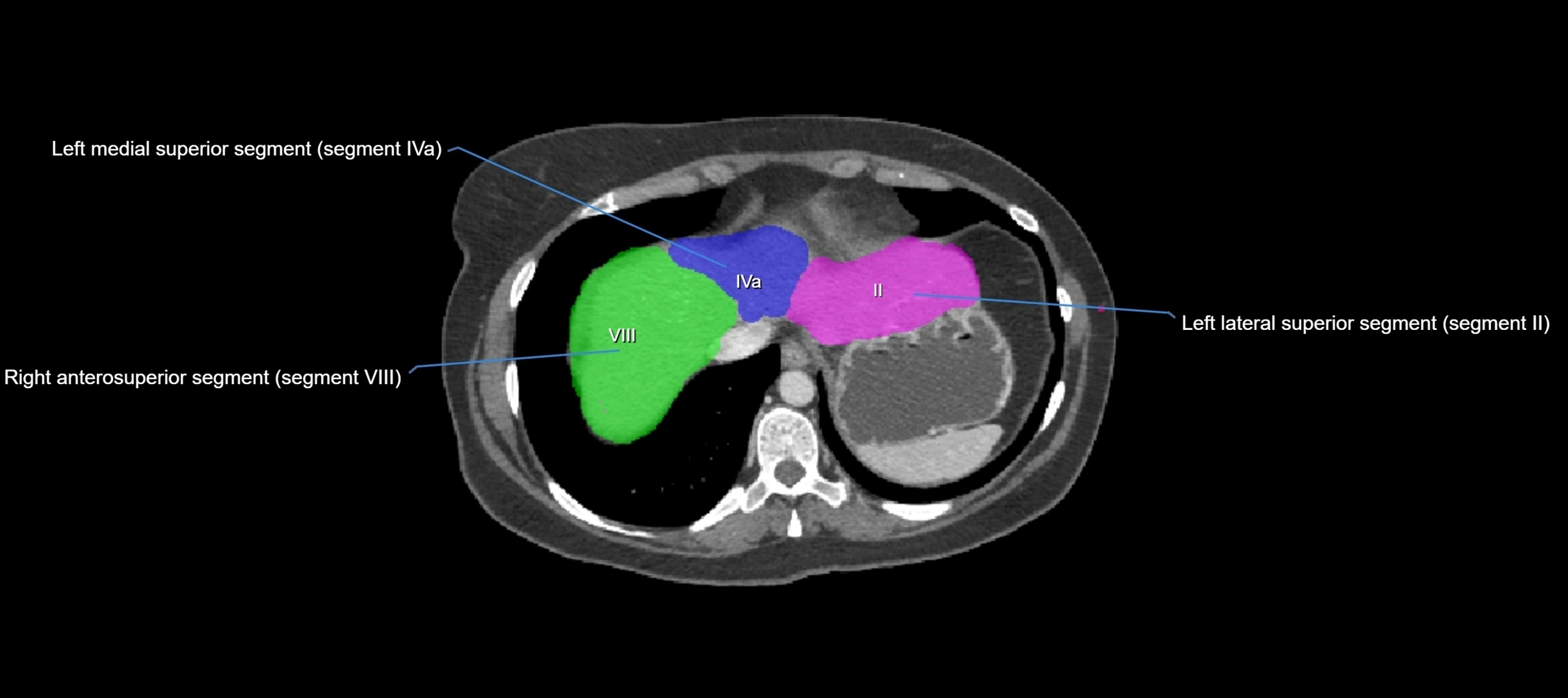 CT liver segments axial cross sectional anatomy labelled image-00070.webp